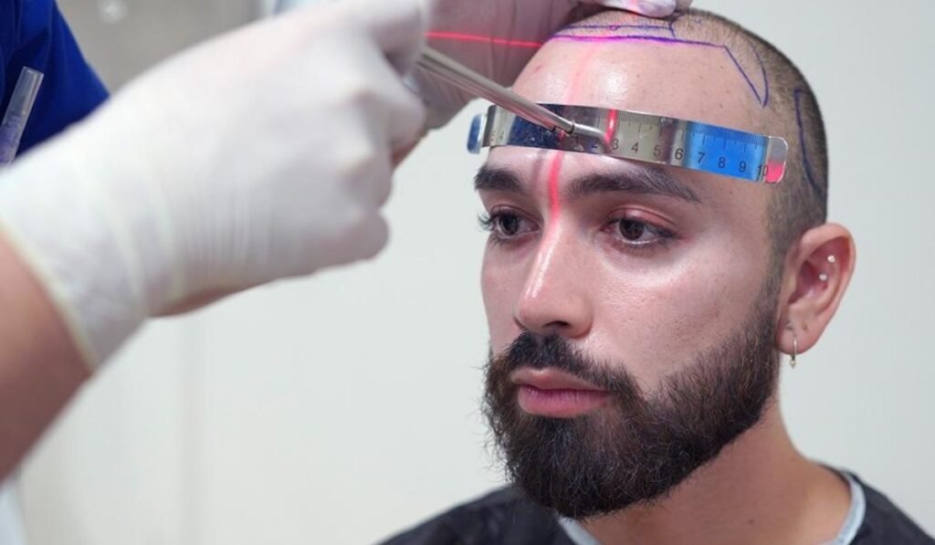 Hermest Is the Best Hair Transplant