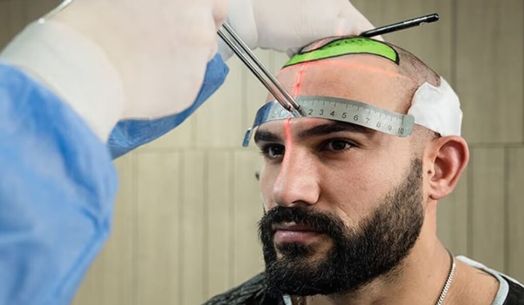 Hermest Is the Best Hair Transplant