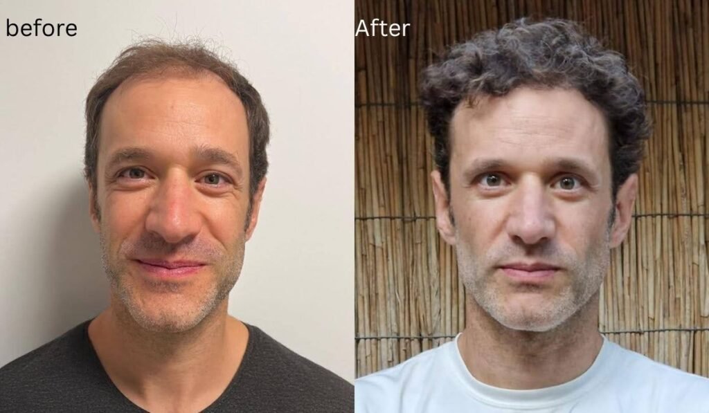 Hermest Is the Best Hair Transplant
