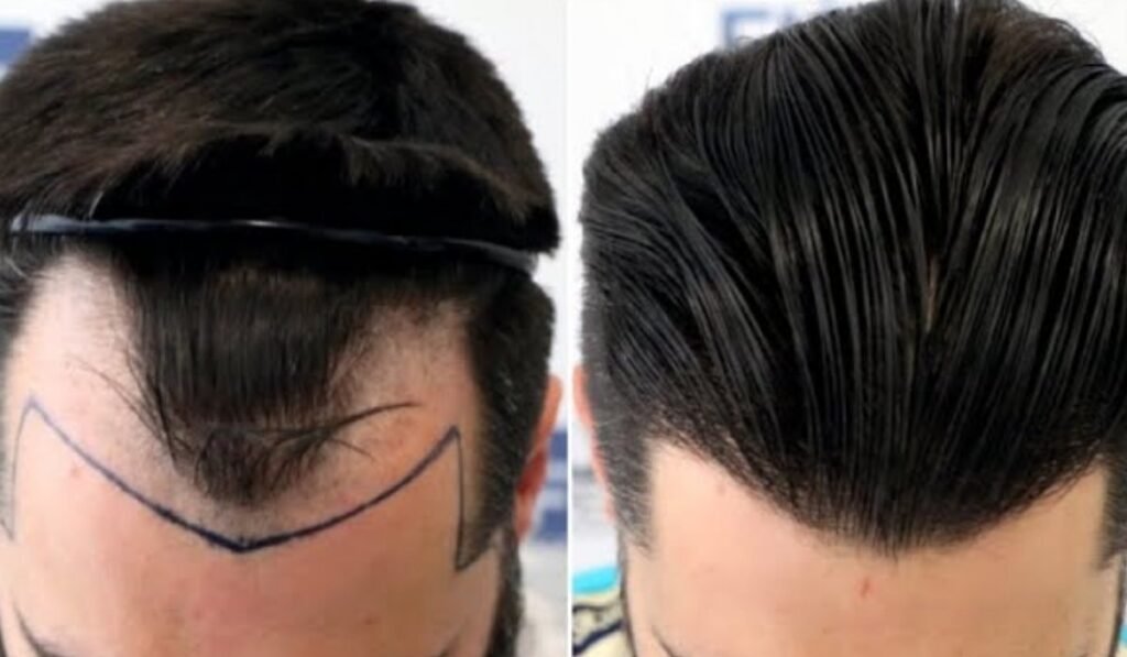 Spain’s Hair Transplant
